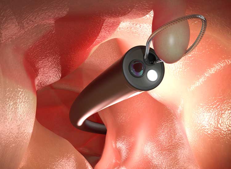 日帰り手術で大腸ポリープ切除が可能